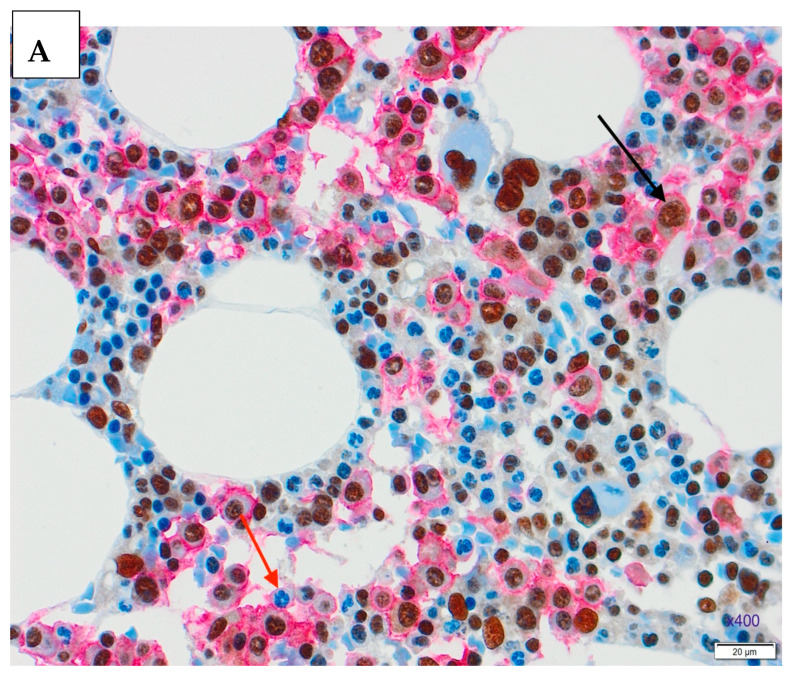 Double staining in the trephine biopsy, CD138 staining with Dako REAL Detection System Alkaline Phosphatase kit K5005, red chromogenic presentation, MDM2 staining with DAB chromogen in brown, x400. ( A ). Newly diagnosed MM trephine biopsy, positive nuclear staining (black arrow) and negative nuclear staining (red arrow). ( B ). Trephine biopsy after the therapy, positive nuclear staining (black arrow) and negative nuclear staining (red arrow).