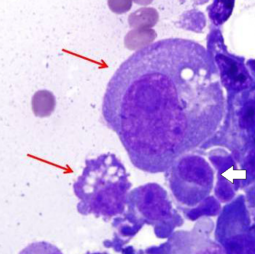 Histopathology of Mott cells with Russell bodies (red arrows) compared to an almost normal plasma cell (white arrow, prominent nucleolus). Primary malignant myelomatous pleural effusion. H&E.