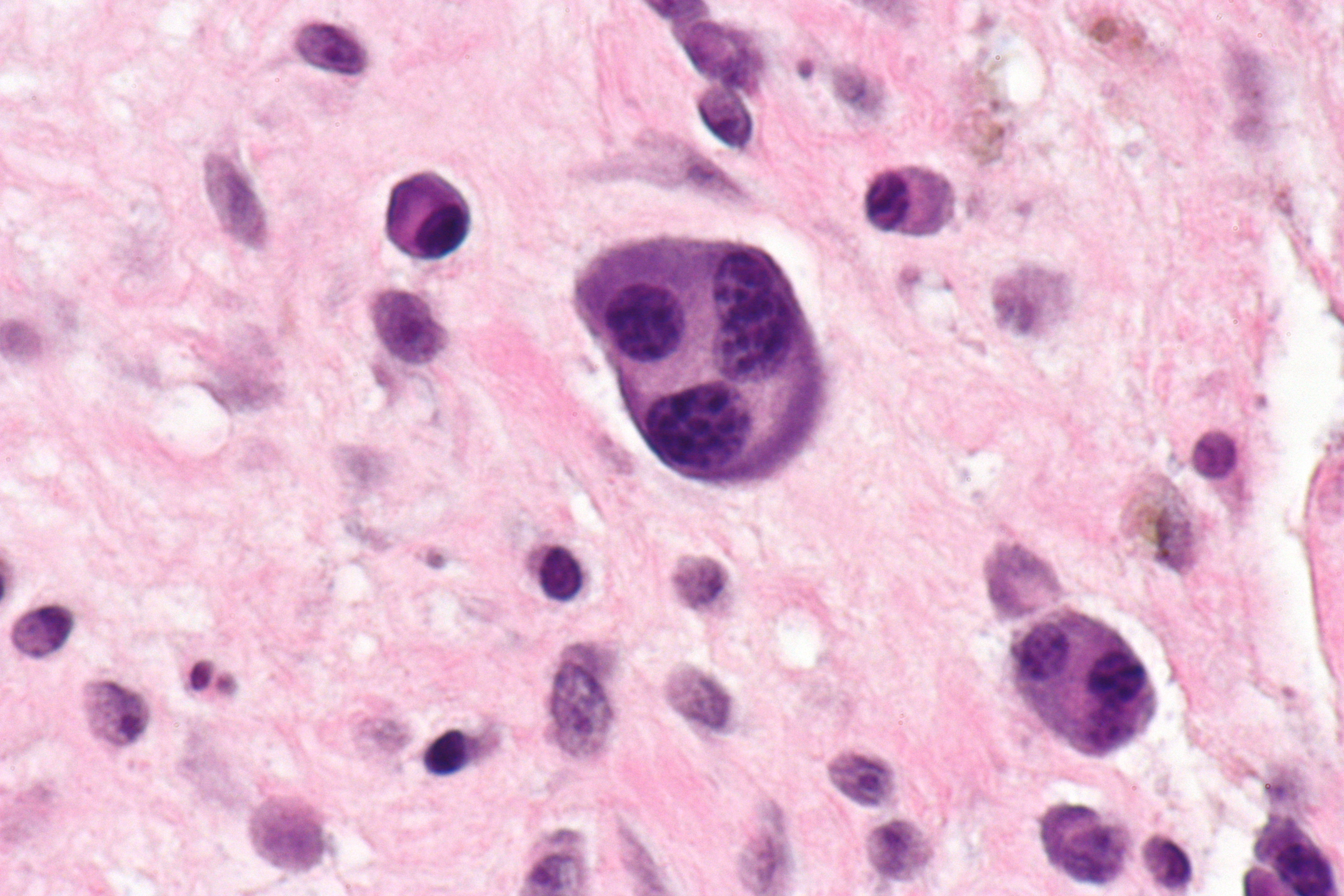 Multinucleated plasma cell, H&E stain, extremely high magnification. An atypical form seen in some myeloma cases.