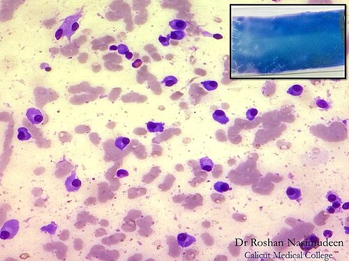 A case of Multiple myeloma and the bone marrow smear shows plasma cells with eccentric nucleus, bluish cytoplasm and a pale Golgi zone. Nuclear details cannot be appreciated at this power. As for the glass slide, naked eye examination itself shows a blue staining. This is due to the romanowsky stain interacting with the fixed paraprotein on the blood/marrow film.