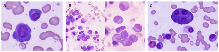 Examples of bone marrow samples colored by May-Grünwald-Giemsa, 1000× magnification. Plasma cell with morphologic immaturity: high nucleus/cytoplasm ratio and dispersed chromatin (A). Binucleated plasma cell and several plasma cells (PC) with dispersed chromatin (B). Bone marrow showing mature PC and a multinucleated plasma cell (C).