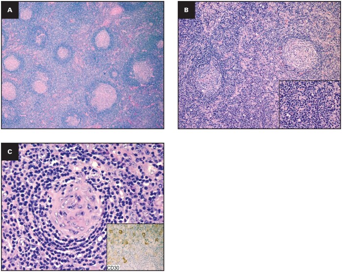 Histopathologic features of plasma cell/plasmacytic idiopathic multicentric Castleman disease. (A) Hyperplastic follicles HE stain in 4x magnification; (B) prominent interfollicular plasmacytosis; HE stain in 10x magnification (inset: HE stain higher magnification- 40x); (C) presence of plasmacytoid immunoblasts 'white circles' HE in 40x magnification (inset: Immunostain CD30-positive immunoblasts in 40x magnification). HE, hematoxylin and eosin.